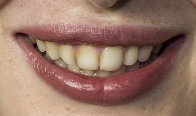 жълти зъби